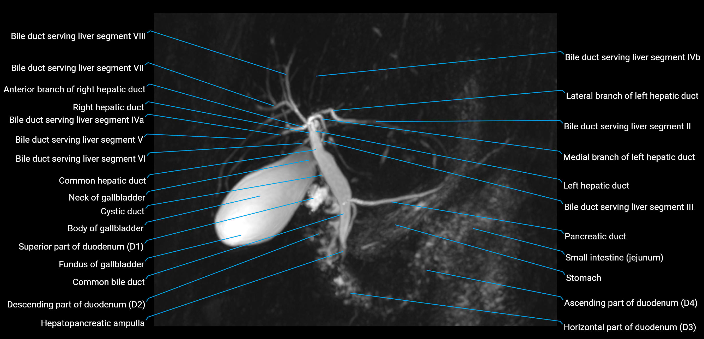 MRCP MIP MRI  anatomy labelled image-img-01003-00009.png